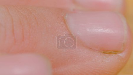 Téléchargez les photos : MACRO, DOF: Unrecognizable person with hands damaged from intensive manual labor rest their fingers on the desk. Highly detailed view of a hard-working person's chapped and cracked fingers and nails. - en image libre de droit