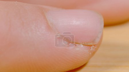 Téléchargez les photos : MACRO, DOF: Fingers damaged by manual labor. High definition close up view of an unrecognizable white person's chapped finger. Detailed shot of a hard-working person's cracked skin of their fingers. - en image libre de droit