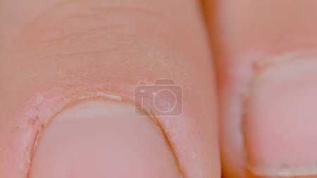 Foto de MACRO, DOF: High definition close up view of an unrecognizable white person's chapped finger. Detailed shot of a hard-working person's cracked skin of their fingers. Fingers damaged by manual labor. - Imagen libre de derechos