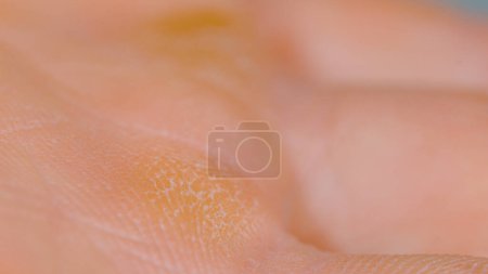 Téléchargez les photos : MACRO, DOF: Hard callouses formed on the palm of an unrecognizable male climber. Detailed shot of a worker's hardened skin on the inside of their hands caused by heavy manual labor. Hardened skin. - en image libre de droit