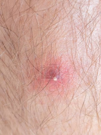 Photo for VERTICAL, CLOSE UP: Detailed shot of an adult male's knee after it gets infected and filled with bacteria. Small cut on a man's knee is infected and filled with abscess. Close up of infected limb. - Royalty Free Image