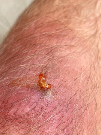 Foto de VERTICAL, CLOSE UP: Yellow puss and blood discharge is oozing out of an infected wound located on male's leg. Close up shot of a painful and sore infection site on grown man's knee as it gets drained. - Imagen libre de derechos