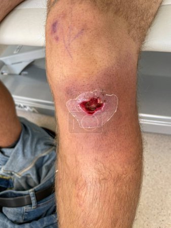 Téléchargez les photos : VERTICAL, CLOSE UP: Detailed close up shot of a young man's open wound after abscess drainage. Drainage surgery leaves a grown male with an open hole in his knee. Emergency room infection treatment. - en image libre de droit