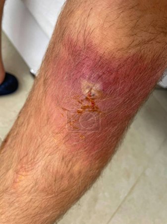 Photo for VERTICAL, CLOSE UP: Close up shot of a painful and sore infection site on grown man's knee as it gets drained. Yellow puss and blood discharge is oozing out of an infected wound located on male's leg. - Royalty Free Image