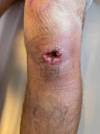 Téléchargez les photos : VERTICAL, CLOSE UP: Drainage surgery leaves a grown male with an open hole in his knee. Detailed close up shot of a young man's open wound after abscess drainage. Emergency room infection treatment. - en image libre de droit