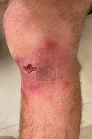 Photo for VERTICAL, CLOSE UP: Drainage site of an infected bruise on a male patient's knee slowly heals during the recovery process. Healing raw flesh is visible inside of a gaping hole in a grown man's knee. - Royalty Free Image