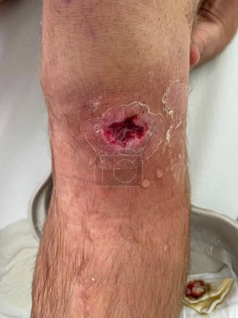 Téléchargez les photos : VERTICAL, CLOSE UP: Unrecognizable young man's open wound gets rinsed with water after a weekly check-up. Raw pink flesh is visible inside of a man's gaping hole in his knee. Rinsed infection site. - en image libre de droit
