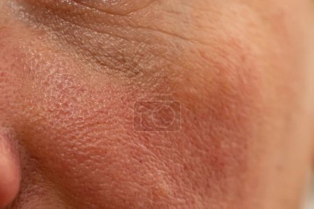 Téléchargez les photos : Vue rapprochée de la joue féminine aux pores dilatés. maladies de la peau, rougeur - en image libre de droit