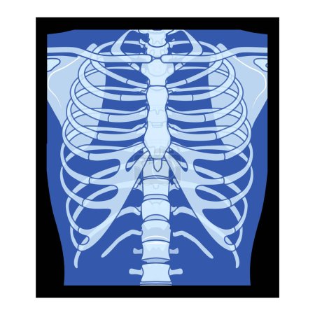 Téléchargez les illustrations : X-Ray Cage thoracique Squelette Corps humain - poitrine, vertèbre, os adultes roentgen vue de face. 3D réaliste bleu plat concept de couleur Illustration vectorielle de l'anatomie médicale isolé sur fond noir - en licence libre de droit