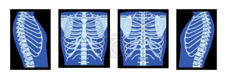 Téléchargez les illustrations : Ensemble de X-Ray cage thoracique Squelette Corps humain - poitrine, vertèbre, os adultes roentgen vue de face arrière. Concept de couleur bleue plate réaliste 3D Illustration vectorielle de l'anatomie médicale isolée - en licence libre de droit