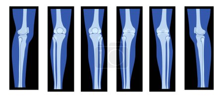 Illustration for Set of X-Ray Knee femur leg Skeleton Human body - Patella, epicondyle, Tibia, Fibula Bones adult people roentgen front back side view. 3D realistic flat concept Vector illustration of medical anatomy - Royalty Free Image