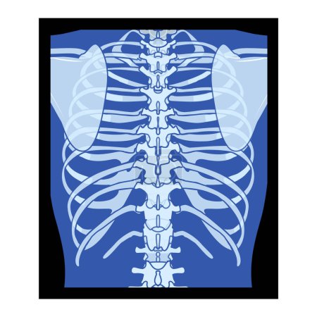 Téléchargez les illustrations : X-Ray Cage thoracique Squelette Corps humain - poitrine, vertèbre, os adultes roentgen vue de dos. 3D réaliste bleu plat concept de couleur Illustration vectorielle de l'anatomie médicale isolé sur fond noir - en licence libre de droit