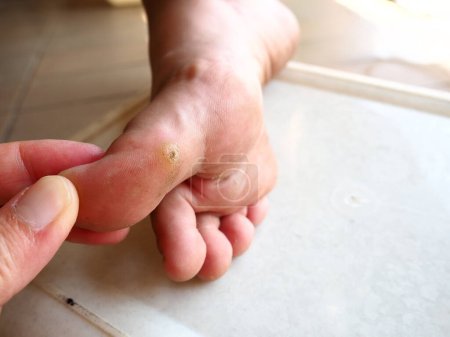 Photo for Plantar warts Verruca plantaris are warts caused by human papillomaviruses HPV appear on the soles or toes. The defeat of the sole of the foot, hard and rough papules, destroying papillary patterns - Royalty Free Image
