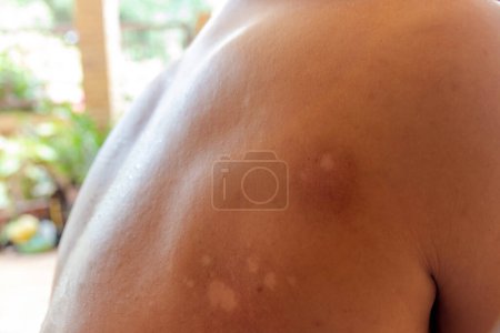 Téléchargez les photos : Macro blanc Pityriasis ou Tinea Versicolor sur la peau du dos, Utilisé pour le concept de soins de la peau, Concepts de soins de santé - en image libre de droit