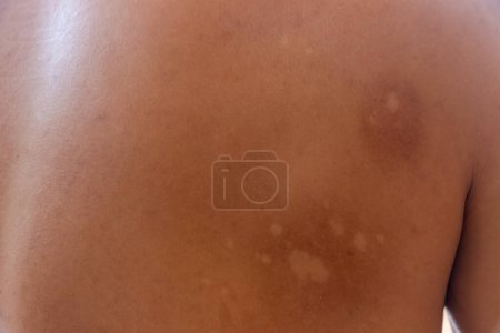 Téléchargez les photos : Macro blanc Pityriasis ou Tinea Versicolor sur la peau du dos, Utilisé pour le concept de soins de la peau, Concepts de soins de santé - en image libre de droit