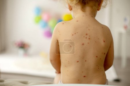 Niña pequeña con varicela en la cama, jugando en casa, aislamiento de cuarentena durante la enfermedad, virus Varicela zóster o erupción de la burbuja de varicela