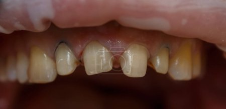Preparation for prosthetic teeth. Teeth treated for prosthetics with crowns. Retraction of the gums with the help of a retraction thread.