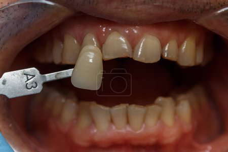 Foto de Determinación del color de los dientes utilizando una muestra. Preparación para dientes protésicos. Odontología estética. Blanqueamiento dental. Sonrisa humana. Salud dental. - Imagen libre de derechos
