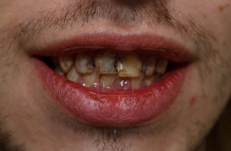 Foto de Un paciente con mala higiene dental. Los dientes están afectados por la caries. Caries dental. Enfermedades de la cavidad oral. Encías inflamadas. Gingivitis. Periodontitis. Dolor de muelas. - Imagen libre de derechos