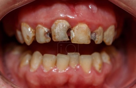 Ein Patient mit schlechter Zahnhygiene. Die Zähne sind von Karies betroffen. Zahnkaries. Erkrankungen der Mundhöhle. Entzündetes Zahnfleisch. Gingivitis. Parodontitis. Zahnschmerzen.
