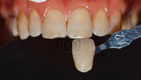 Foto de Determinación del color de los dientes utilizando una muestra sobre un fondo negro. Preparación para dientes protésicos. Odontología estética. Blanqueamiento dental. Sonrisa humana. Salud dental. - Imagen libre de derechos