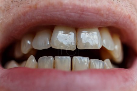 Foto de Dientes frontales y labios humanos de cerca. Color natural de los dientes. Esmalte dental translúcido. Un hueco entre los dientes. Diastema. - Imagen libre de derechos