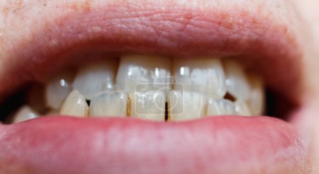 Foto de Dientes frontales y labios humanos de cerca. Color natural de los dientes. Esmalte dental translúcido. Un hueco entre los dientes. Diastema. - Imagen libre de derechos
