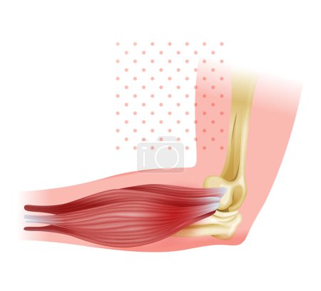 Illustration for Lateral Epicondylitis known as Tennis Elbow - Stock Illustration as EPS 10 File - Royalty Free Image