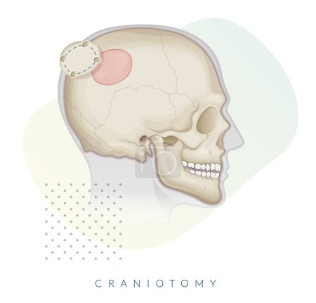 Ilustración de Cirugía de craneotomía - Extirpación de colgajo óseo - Ilustración de stock como archivo EPS 10 - Imagen libre de derechos