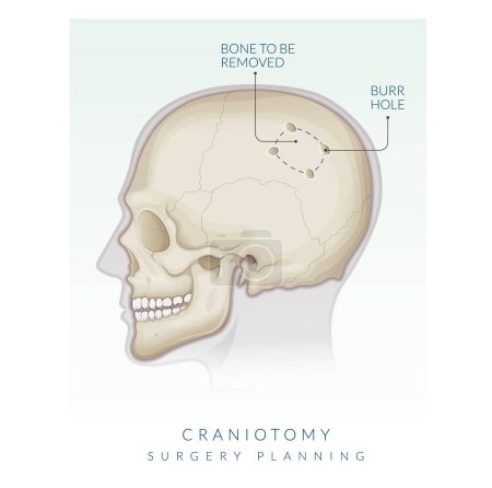 Illustration for Craniotomy Surgery - Bone Flap Removal - Stock Illustration as EPS 10 File - Royalty Free Image
