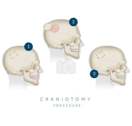 Illustration for Craniotomy Surgery - Bone Flap Removal - Stock Illustration as EPS 10 File - Royalty Free Image