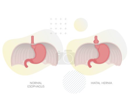 Illustration for Hiatal Hernia - Hiatus Opening in Diaphragm - Stock Illustration as EPS 10 File - Royalty Free Image