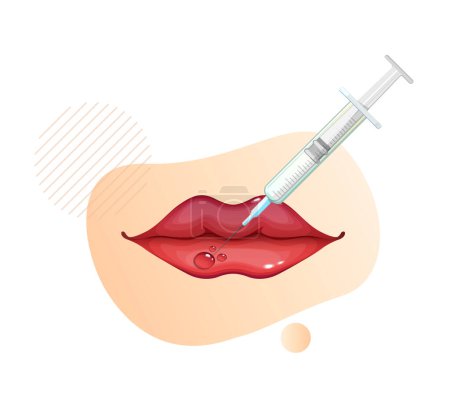 Inyección de toxina botulínica en los labios - Ilustración de stock como archivo EPS 10