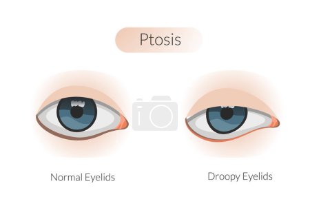 Ptosis drooping upper eyelid - Stock Illustration as EPS 10 File
