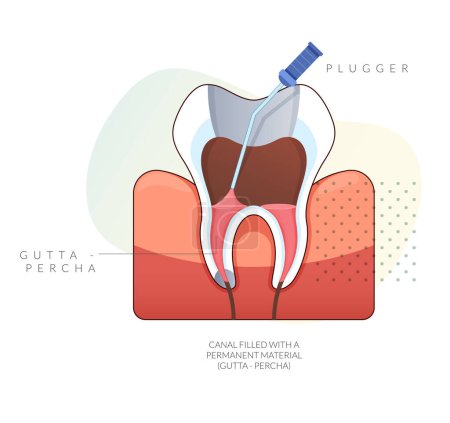 Infected Teeth - Root Canal Treatment - Stock Illustration as EPS 10 File