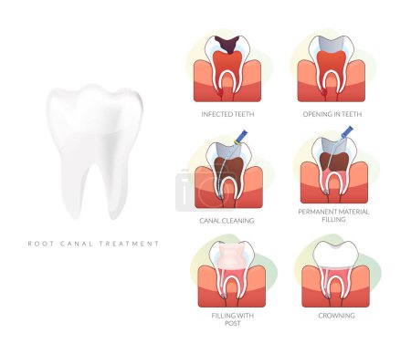 Procédure dentaire - Traitement des canaux radiculaires - Illustration de stock en tant que fichier EPS 10
