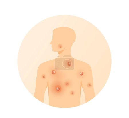 Monkeypox - Skin Rashes and Spots as Symptoms - Icon as EPS 10 File