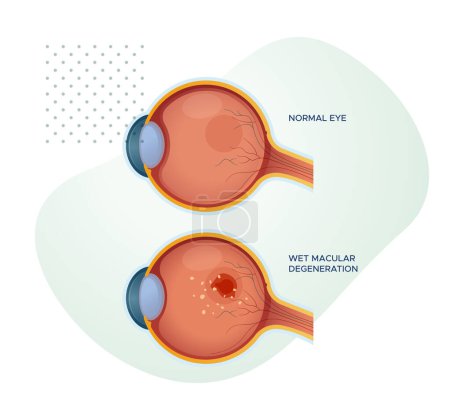Ojos saludables vs degeneración macular húmeda - Ilustración de stock como archivo EPS 10