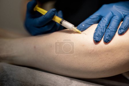 Téléchargez les photos : Phlébologue fait des injections dans une veine, effectuer une sclérothérapie sur les veines de la jambe des femmes, gros plan. Concept de traitement médical des varices - en image libre de droit