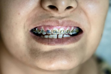 Téléchargez les photos : Jeune fille montrant ses dents accolade dentiste sous un angle différent - en image libre de droit