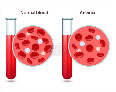 Dos tubos de ensayo con sangre normal y un espécimen con anemia. Trombocitos, leucocitos y eritrocitos bajo el microscopio. Prueba de microbiología. Ilustración vectorial EPS 10