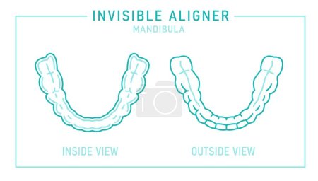 Illustration for Orthodontic silicone trainer. Invisible braces aligner, retainer. Medical scheme. Inside and outside view. Under jaw. Horizontal poster. Editable vector illustration isolated on a white background. - Royalty Free Image