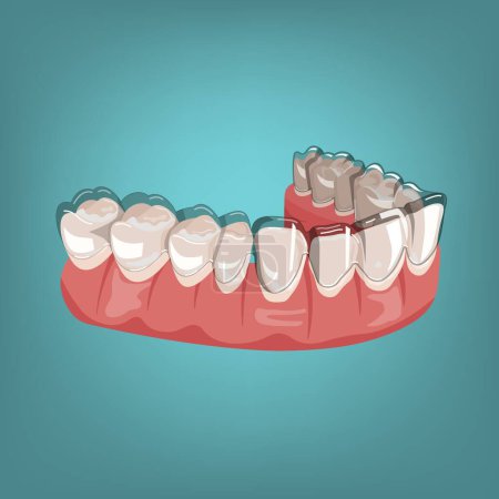 Illustration for Orthodontic silicone trainer. Invisible braces aligner, retainer. Medical drawing in cartoon style. Outside view. Under jaw. Mandibula. Editable vector illustration isolated on a blue background. - Royalty Free Image