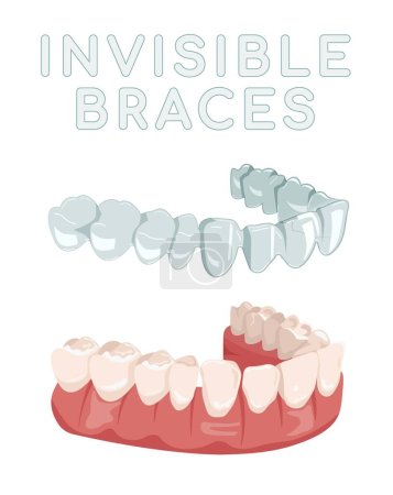 Illustration for Orthodontic silicone trainer. Invisible braces aligner, retainer. Medical drawing in cartoon style. Outside view. Under jaw. Mandibula. Editable vector illustration isolated on a white background. - Royalty Free Image
