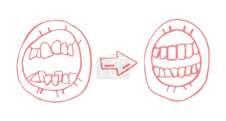 Illustration for Orthodontic treatment result. Invisible braces aligner, retainer. Medical scheme. Stomotology, orthodontics therapy concept. Landscape poster. Editable vector illustration isolated on white background - Royalty Free Image
