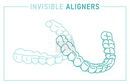 Illustration for Orthodontic silicone trainer. Invisible braces aligner, retainer. Outside view. Under, upper jaw. Mandibula, Maxilla. Horizontal medical poster. Editable vector illustration on a white background. - Royalty Free Image