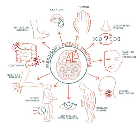 Parkinsons disease symptoms. Mental deficiency, unstable posture, rigidity, drooling. Medical infographic with linear icons. Editable vector illustration in line style isolated on a white background