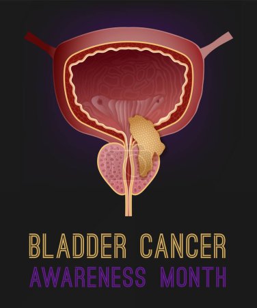Urothelial carcinoma portrait poster. Urinary bladder cancer banner. Medical print. Bladder tumor. Adenocarcinoma. Hematuria. Vertical print. Editable vector illustration on colorful background
