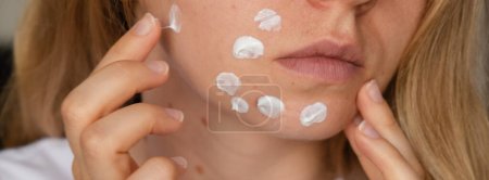Photo for Unrecognizable woman applies makeup, cream serum cure for acne on face. Close-up acne on womans face with rash skin ,scar and spot that allergic to cosmetics. Banner Problem skincare and health - Royalty Free Image