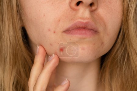 Téléchargez les photos : Femme méconnaissable montrant son acné sur le visage. Gros plan sur l'acné des femmes face à une éruption cutanée, cicatrice et tache allergique aux cosmétiques. Problème de soins de la peau et concept de santé. Rides, mélasmes, obscurité - en image libre de droit